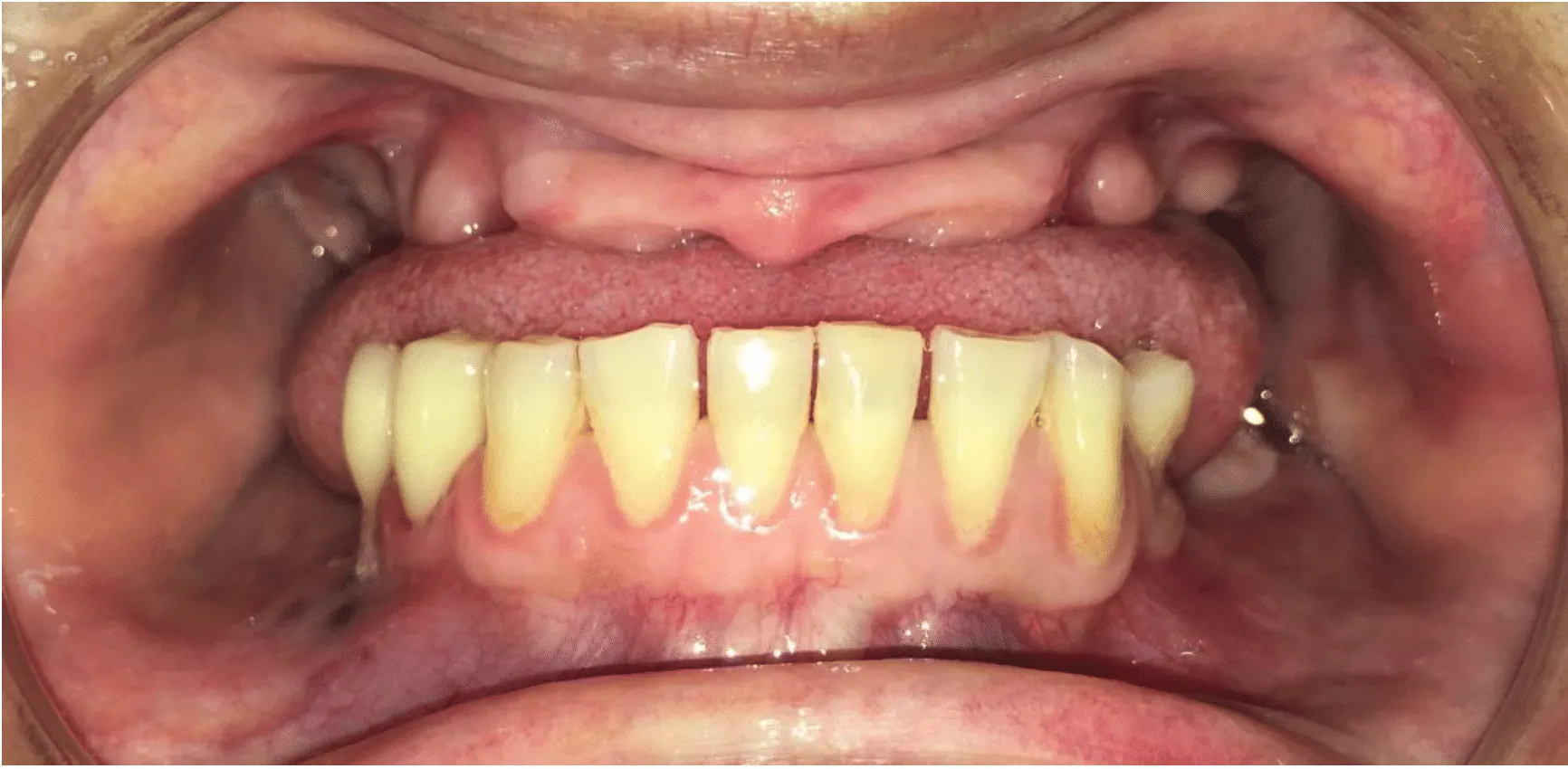 Screen Shot 2019-11-21 at 3.55.50 PM Man Missing Upper-Teeth