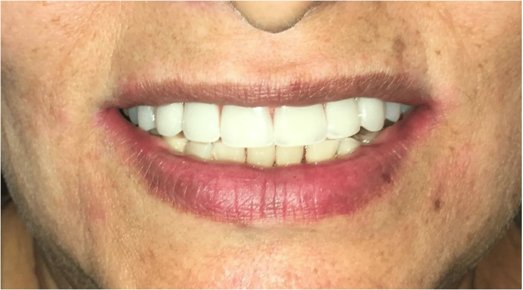 Implants Replacement