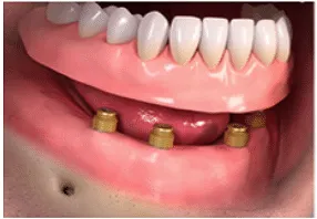 Overdentures1