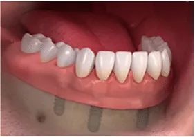 Overdentures2
