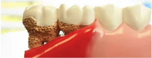 Gum Disease