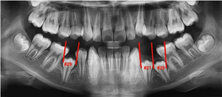 Dental scan showing a child primary baby teeth and developing adult teeth