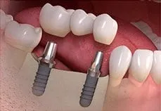 bridge suppoted by multiple implants