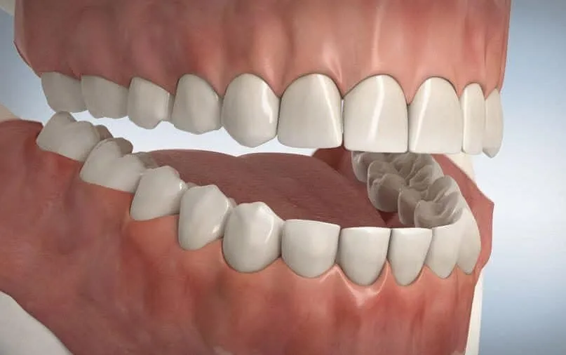 Dentures