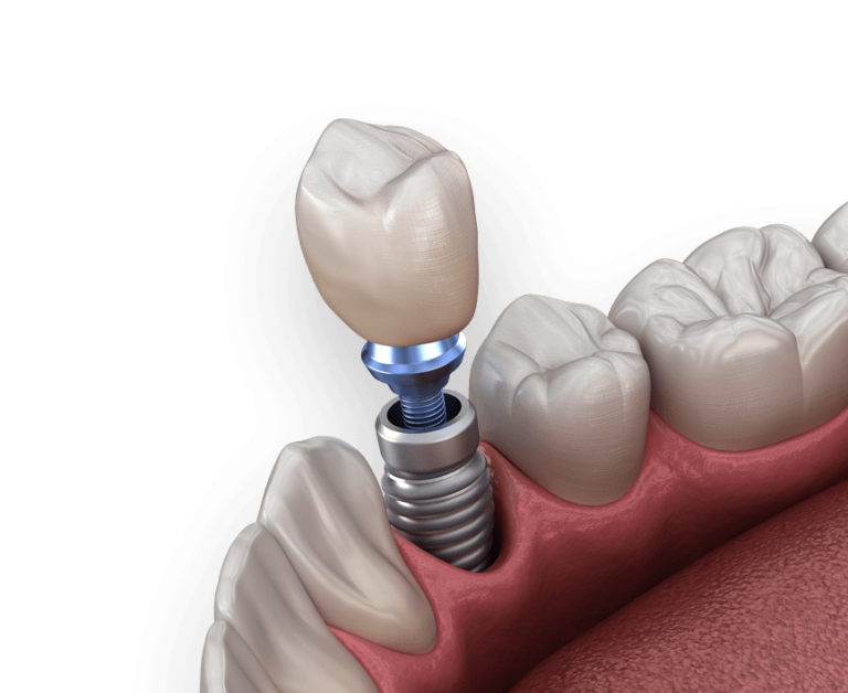Dental implant with abutment and crown shown in the jawbone