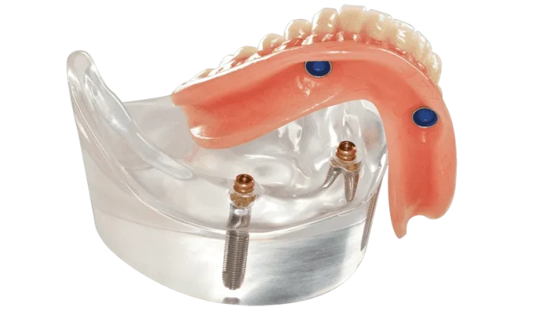 snap on denture