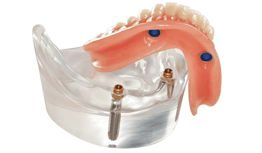 snap on denture