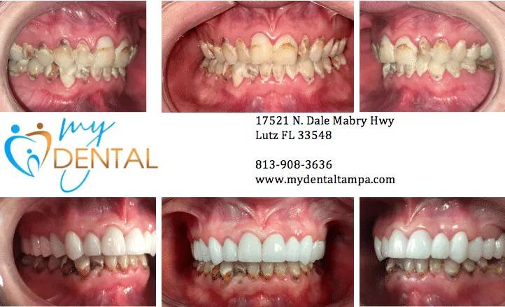 Complete Smile Makeover