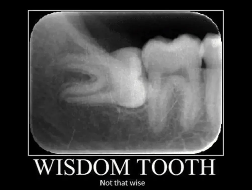 Wisdom teeth