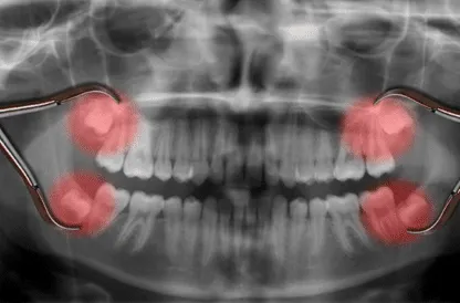 impacted wisdom teeth