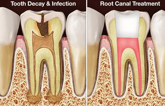 root canals