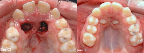 tooth exposure