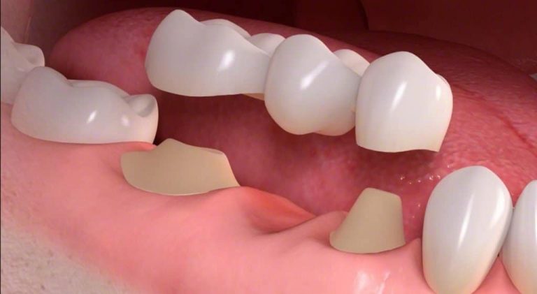Illustration of a three-unit dental bridge placed over a gap in the lower jaw