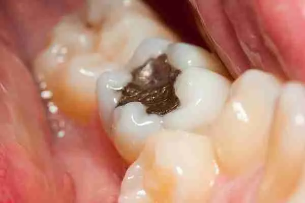 Close-up of a molar with dark decay in the chewing surface before a filling