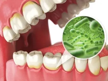 Dental plaque