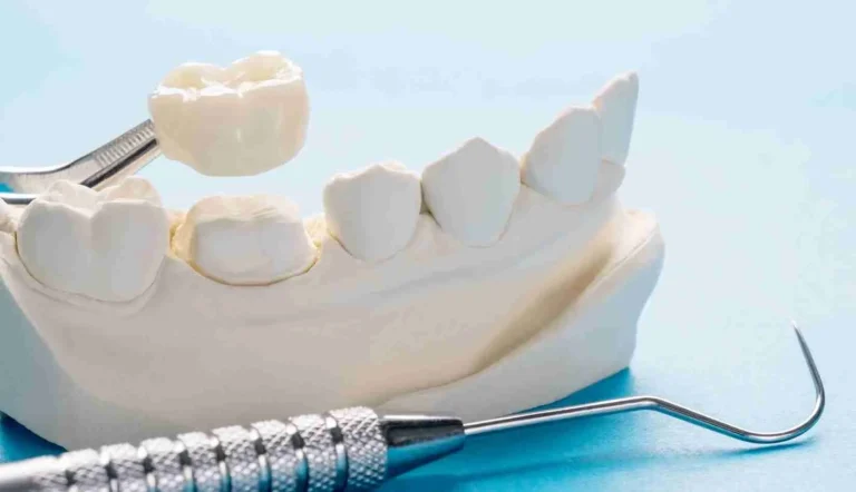 Dental crown positioned over a prepared molar on a study model beside instruments