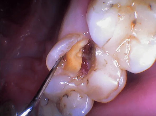 Close-up of a root canal treated tooth that fractured after getting a filling instead of a protective crown