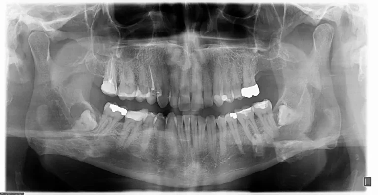 Panoramic dental X-ray showing upper and lower arches including wisdom teeth
