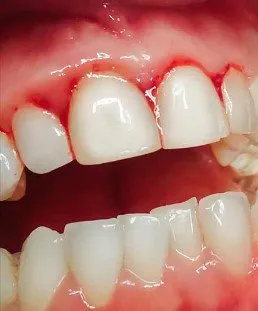 Close-up of inflamed, receding gums bleeding at the gumline from periodontitis