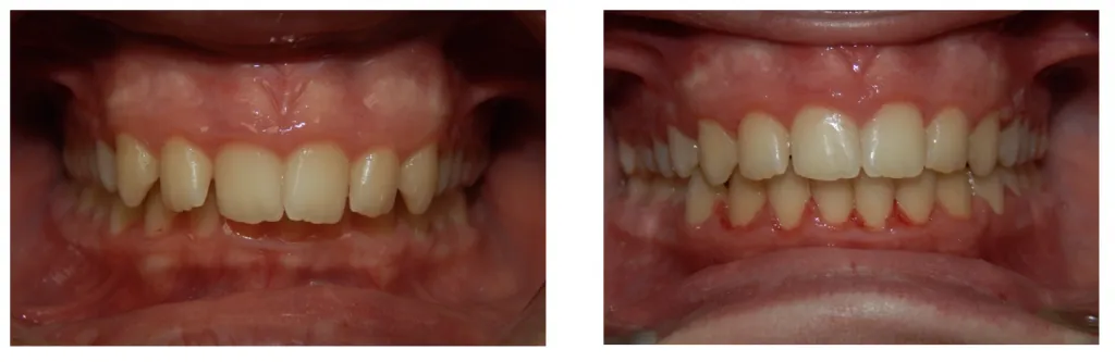 Deep bite correction