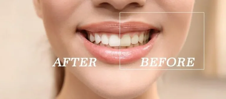 Before and after comparison of tooth color following teeth whitening