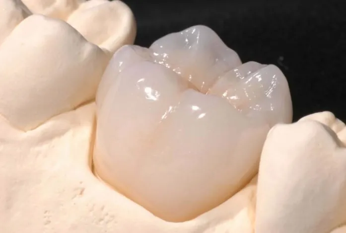 Ceramic dental restoration seated on a stone model of a molar