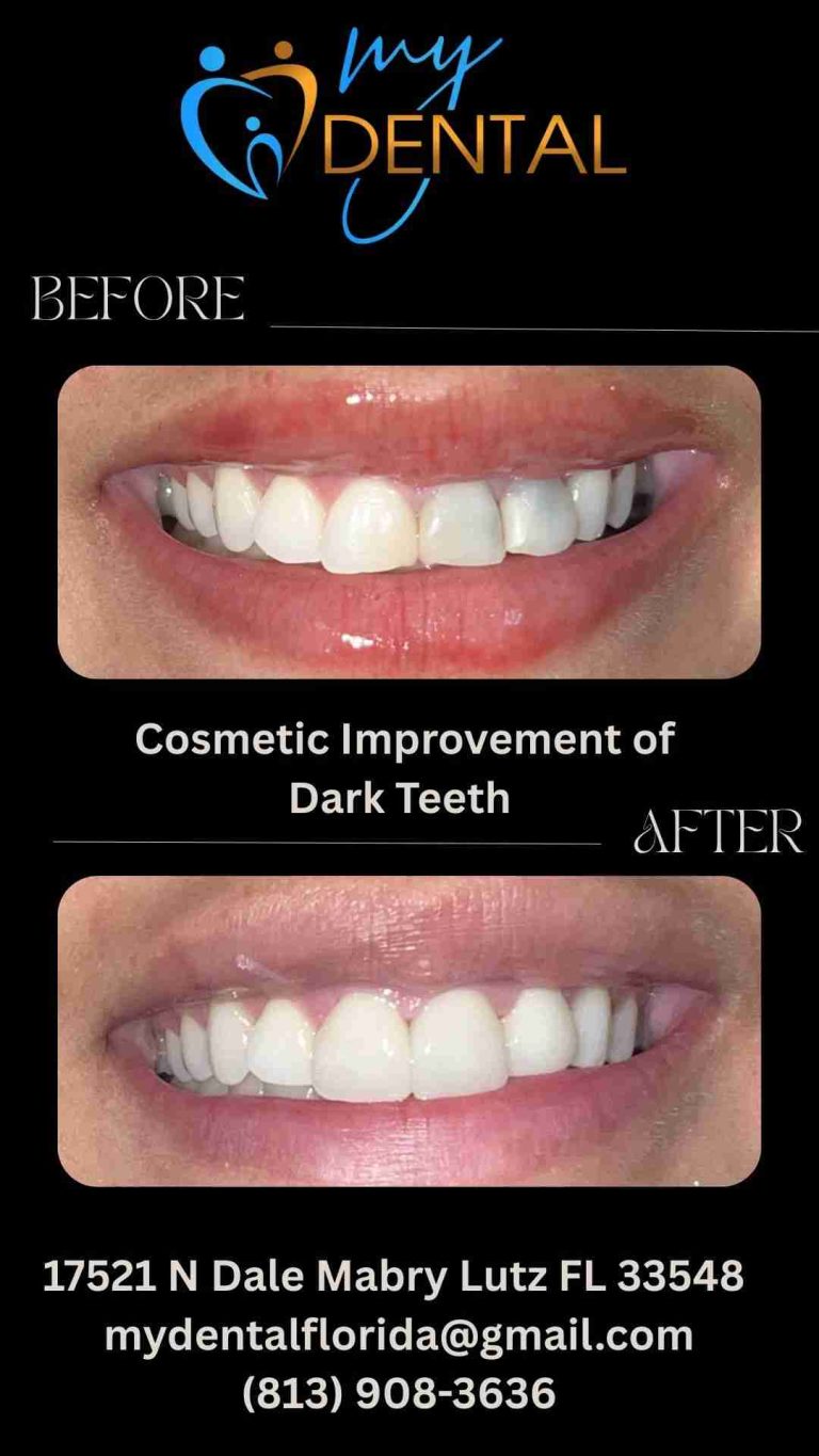 Dark tooth after root canal