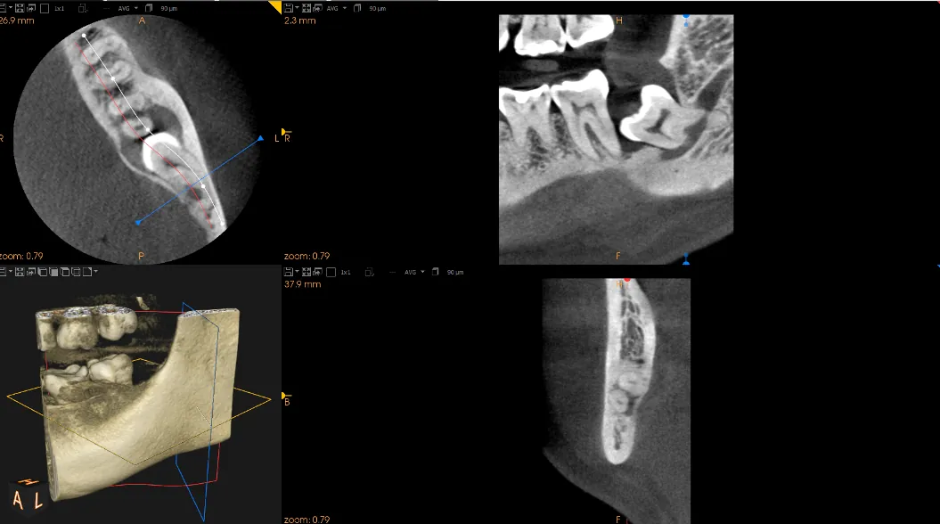 CBCT