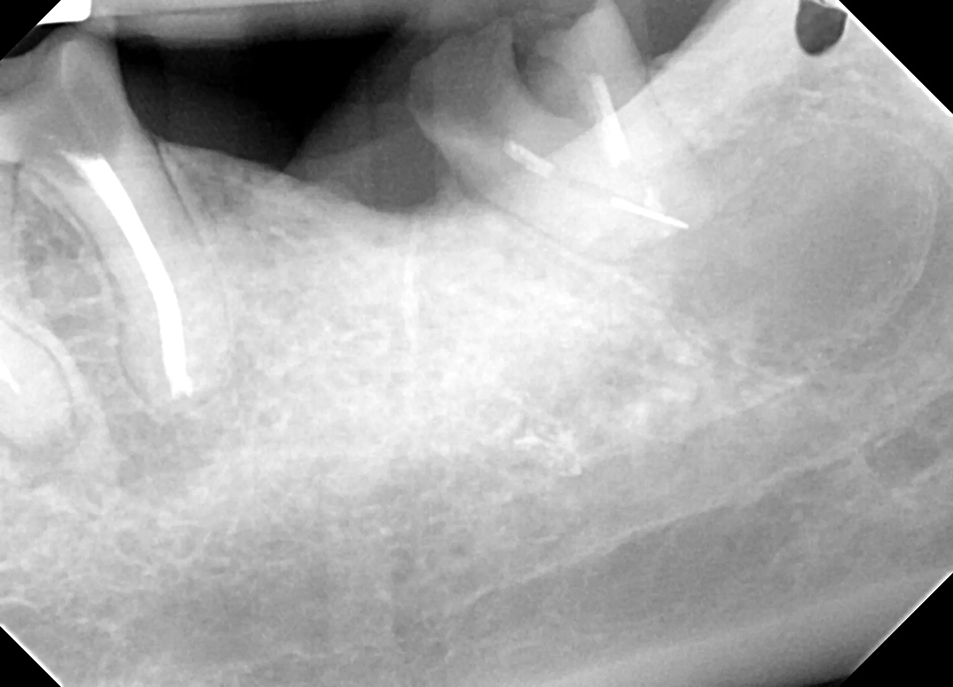 cyst at root tip of broken wisdom tooth