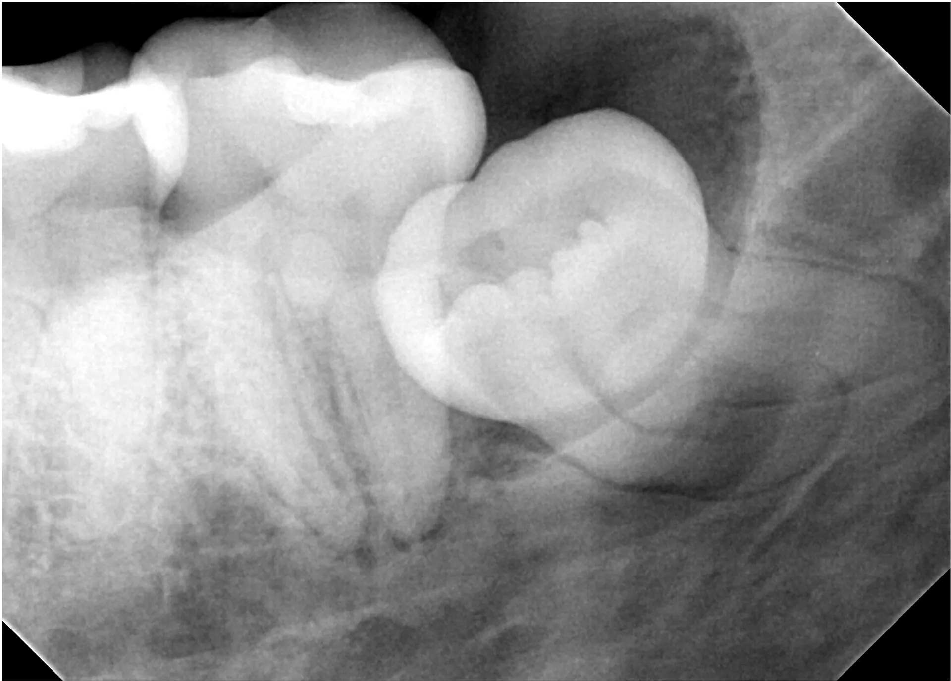 horizontally impacted wisdom tooth forming cyst