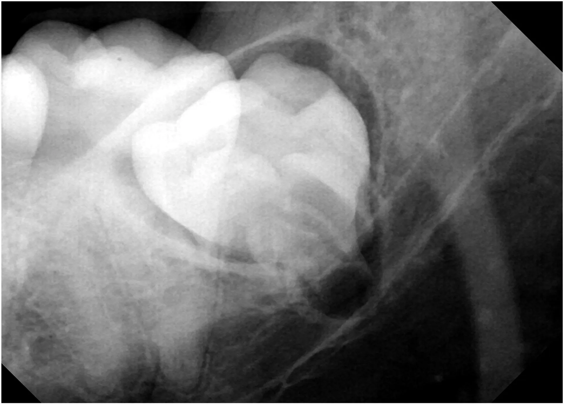 wisdom tooth fully developed