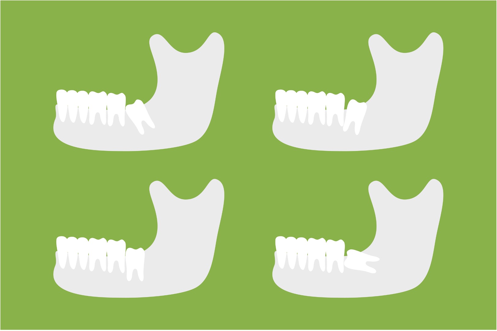 types of impacted wisdom teeth