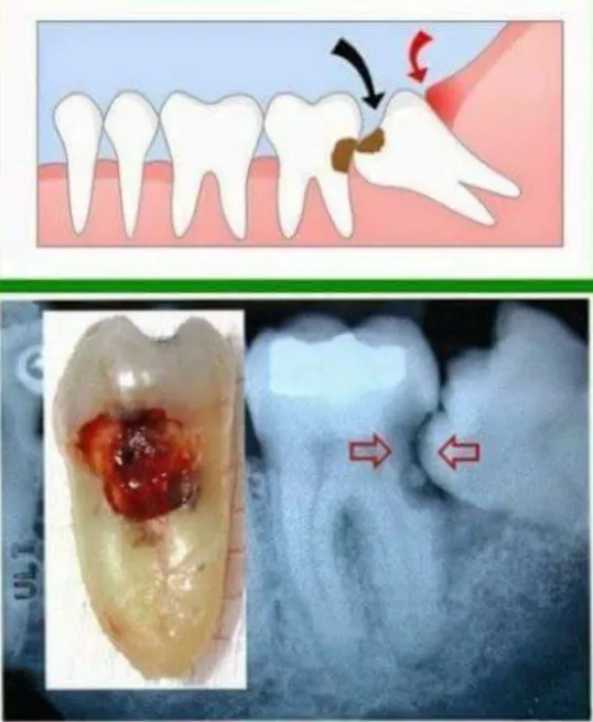 tooth decay in neighboring tooth