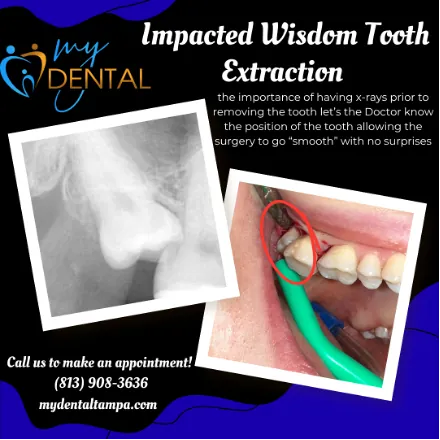 Educational graphic showing an intraoral X-ray and clinical photograph of an impacted wisdom tooth before surgical extraction at MyDental in Lutz, FL.