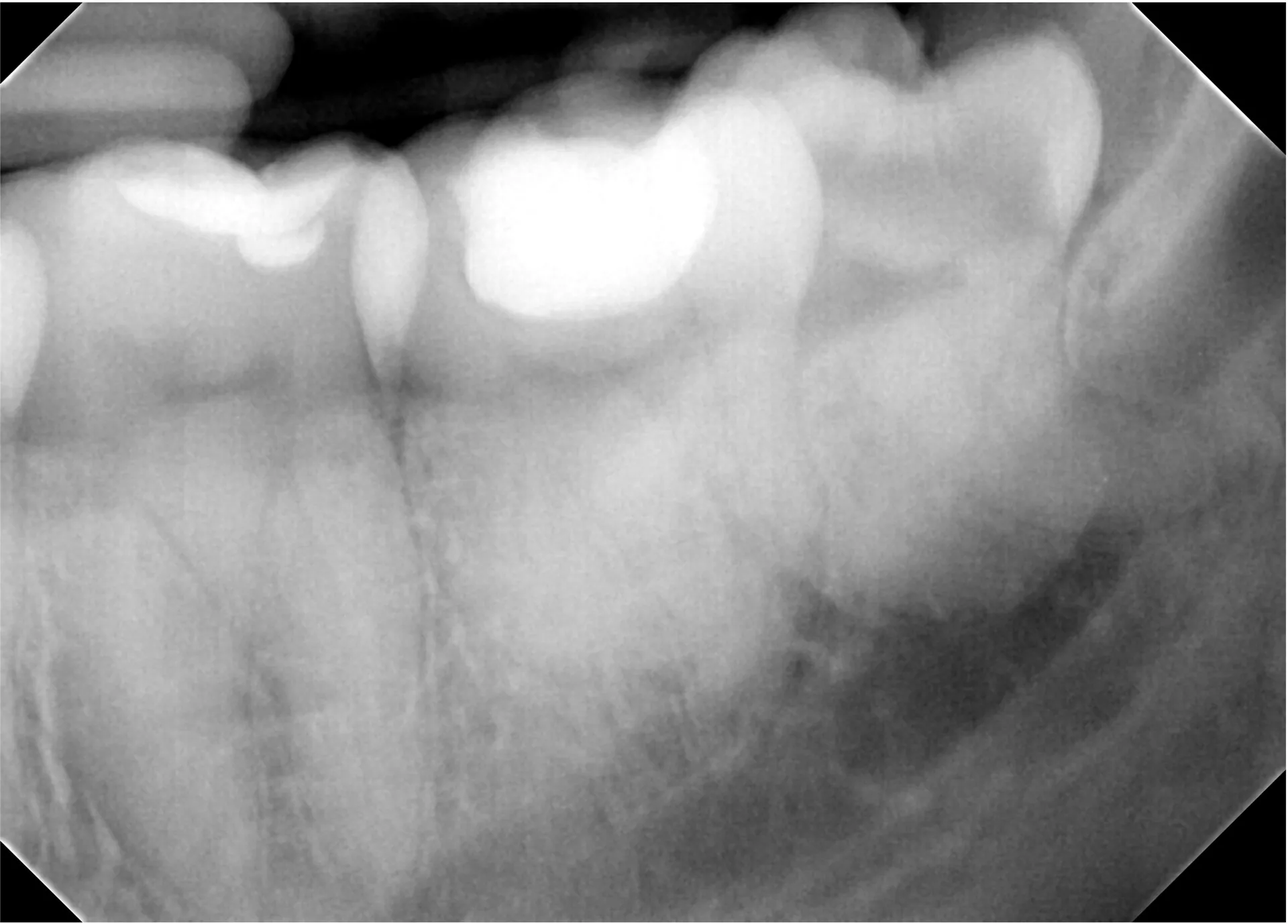 tooth decay in wisdom tooth