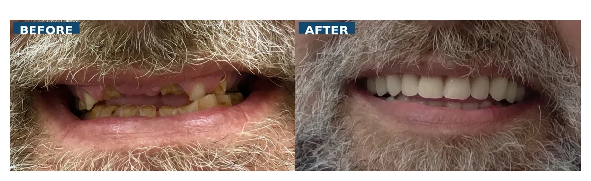 Before and after All-on-4 dental implants replacing severely worn and broken teeth caused by grinding in Lutz Tampa FL