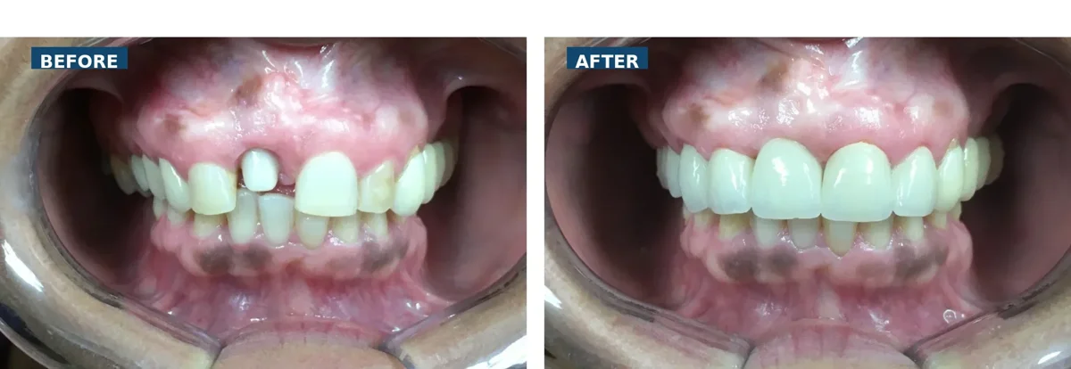 Before and after full arch crowns correcting broken implant crown and uneven yellow teeth in Lutz Tampa FL