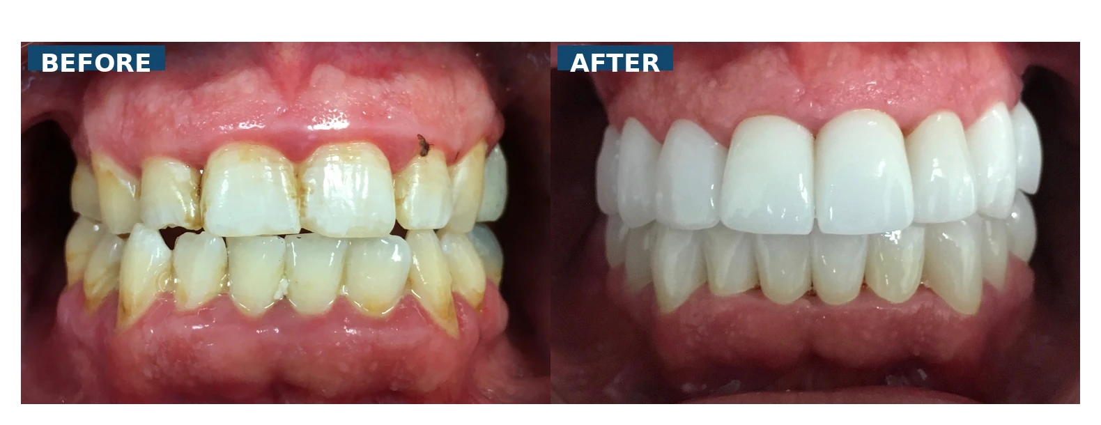 Before and after full arch crowns and gingivoplasty correcting worn yellow teeth and uneven gum levels in Lutz Tampa FL