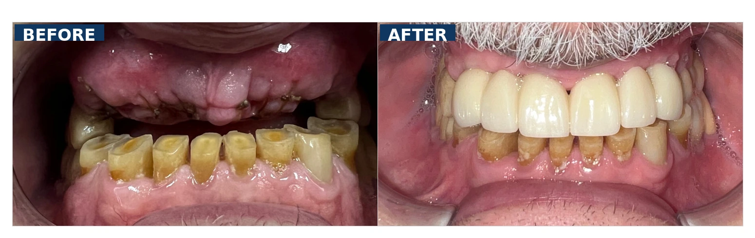 Before and after dental implant bridge restoration of severely worn and decayed upper teeth removed due to advanced decay and infection in Lutz Tampa FL