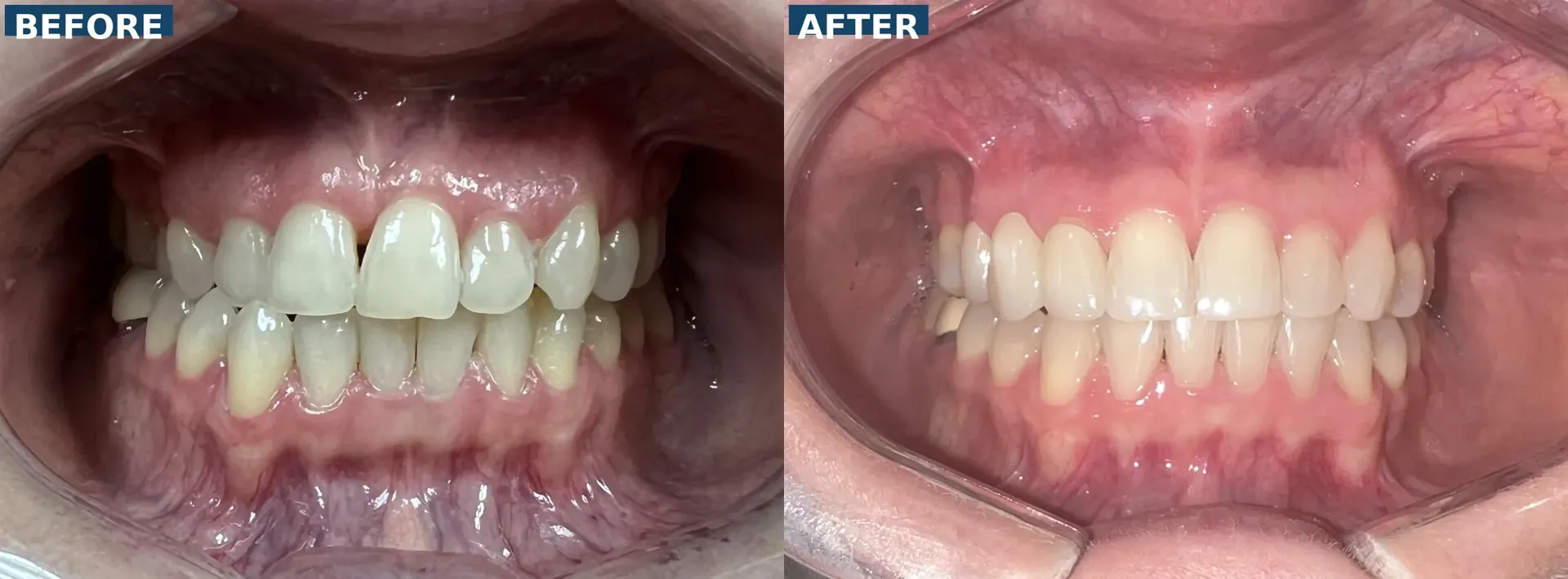 Orthodontic treatment with braces correcting midline shift and missing canine restored with bridge in Lutz Tampa FL