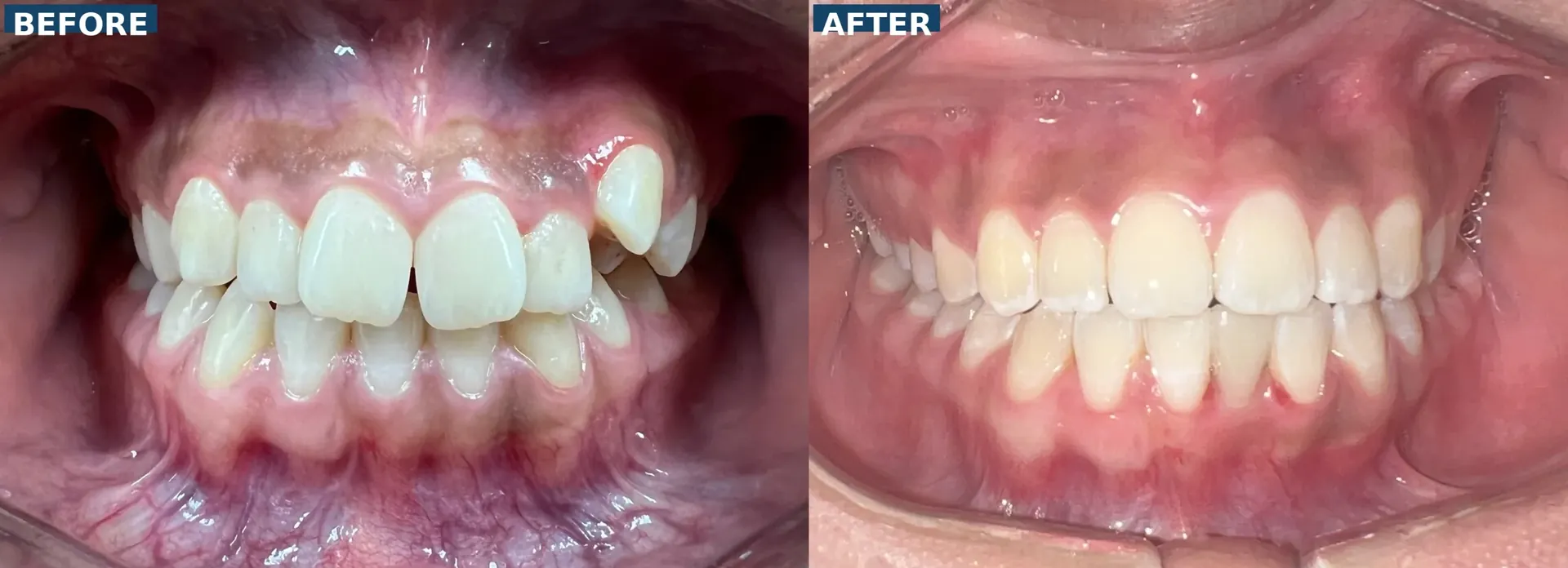 Orthodontic treatment with braces correcting narrow lower arch and missing front tooth with temporary replacement in Lutz Tampa FL