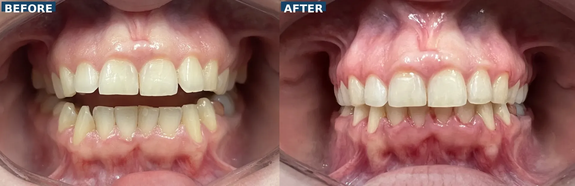 Orthodontic treatment with braces correcting open bite where front teeth did not touch in Lutz Tampa FL