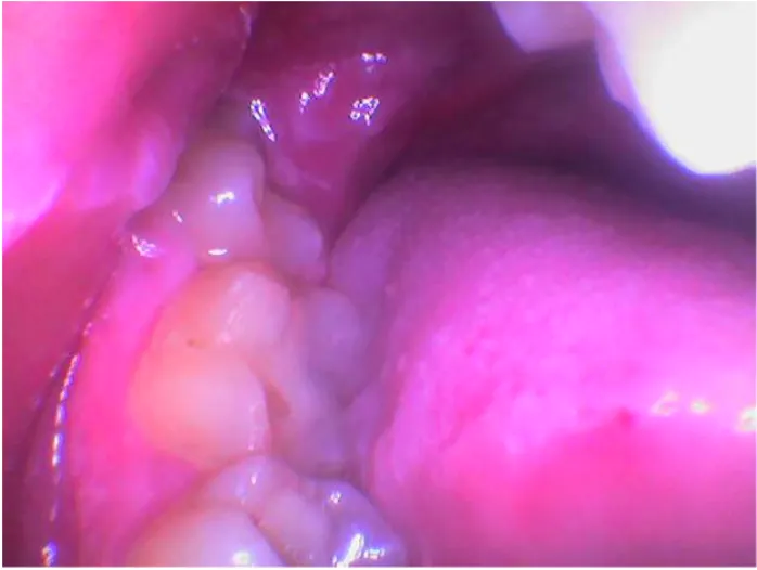 impacted wisdom tooth gum swelling