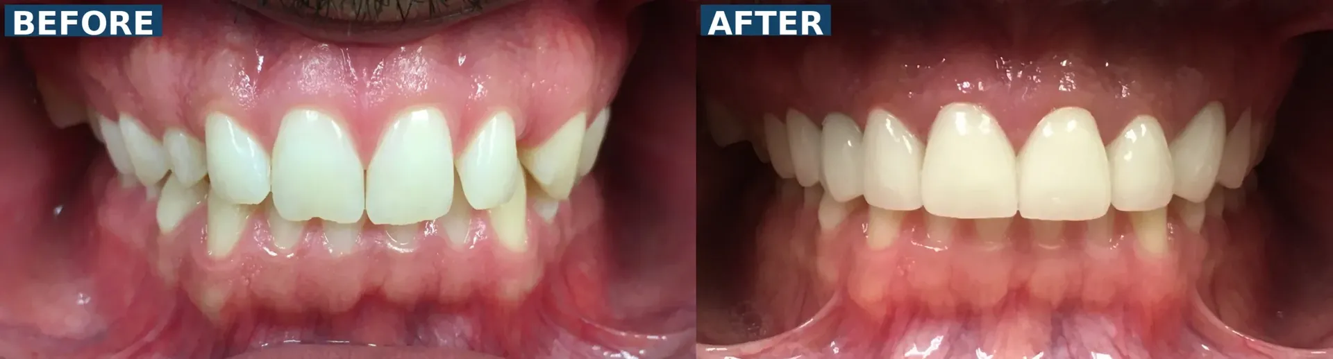 Uneven smile with missing tooth corrected using dental crowns and dental implant in Lutz Tampa FL