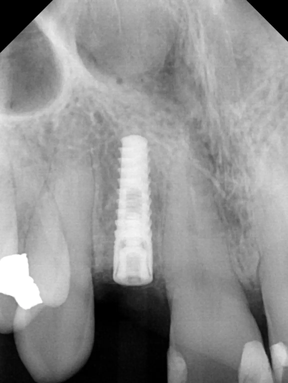 Dental x-ray showing single titanium dental implant replacing a missing upper tooth.