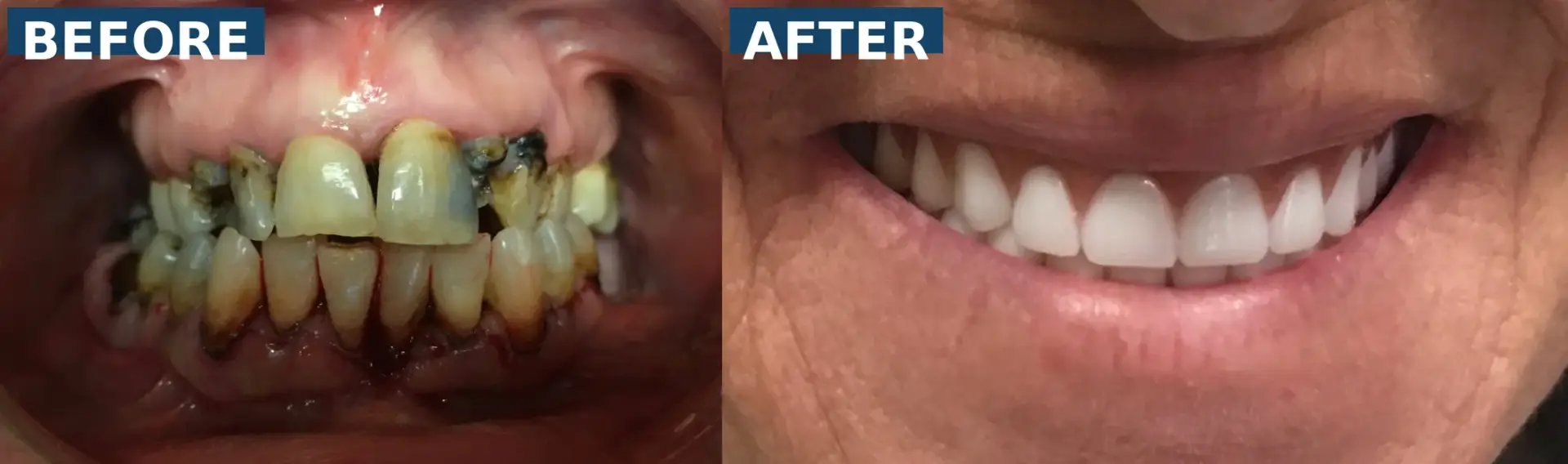 Severely decayed upper and lower teeth replaced with full removable dentures in Lutz Tampa FL