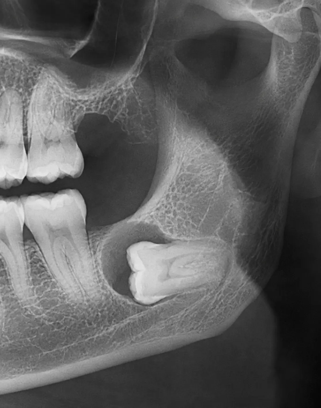 Dental X-ray showing impacted lower wisdom tooth with associated cyst formation in the jaw prior to oral surgery extraction.