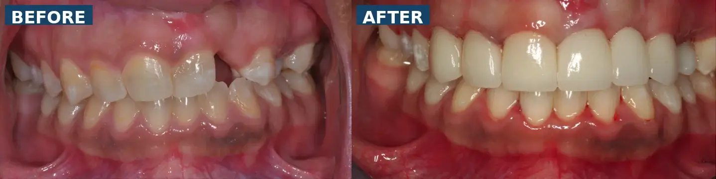 Missing upper lateral incisor replaced with dental bridge and smile correction in Lutz Tampa FL
