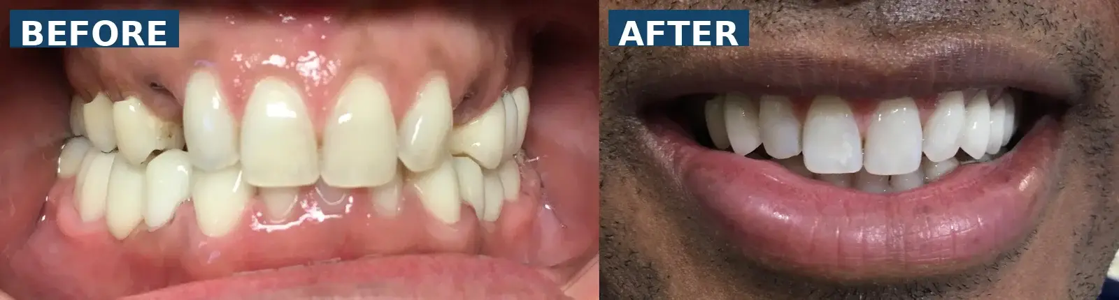 Missing upper canines restored with dental implants and implant crowns in Lutz Tampa FL