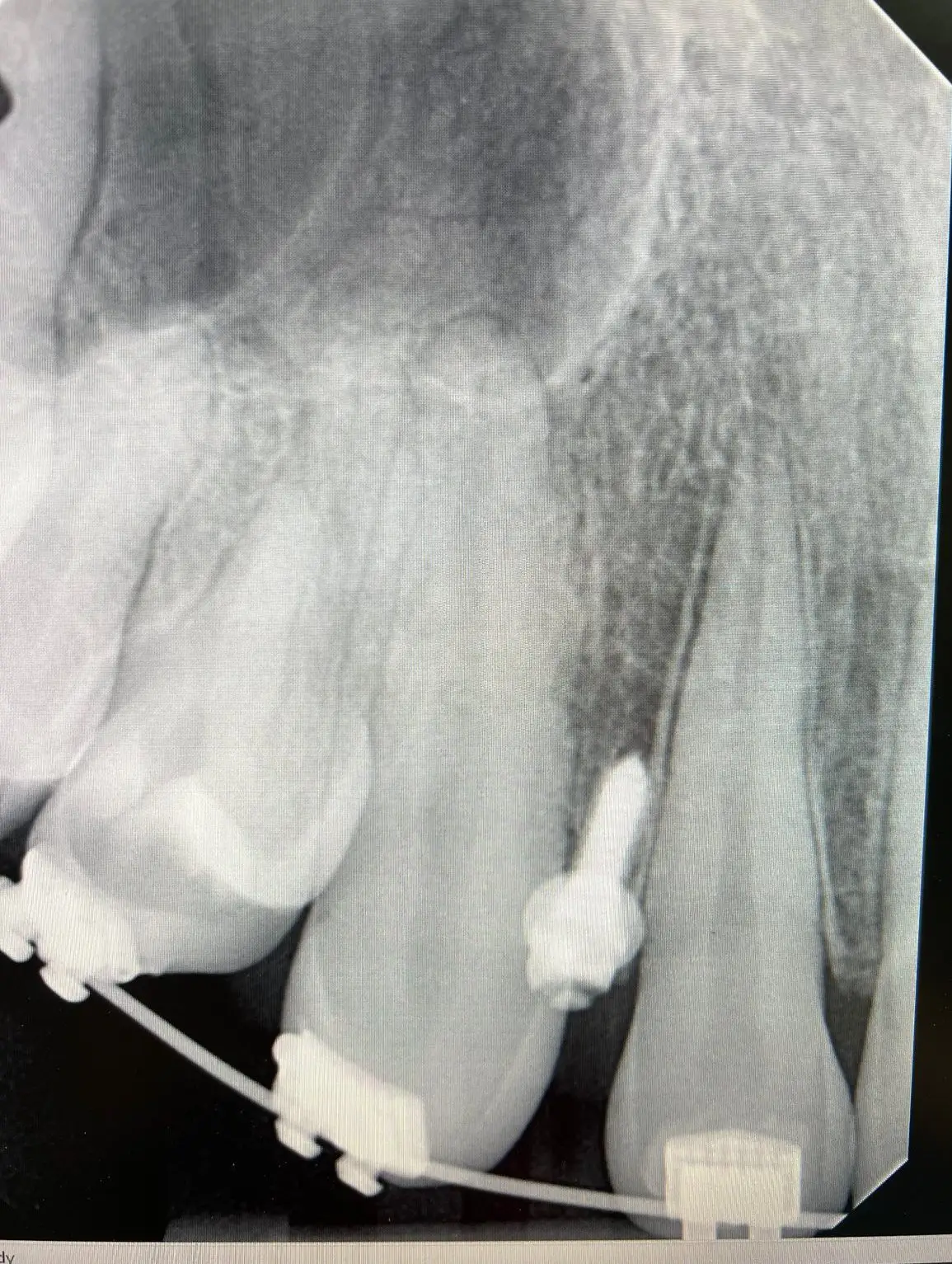 Dental x-ray showing orthodontic TAD mini-implant used with braces for skeletal anchorage and controlled tooth movement.